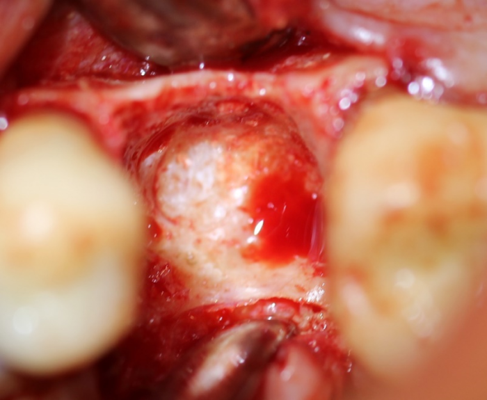 sclerotic bone remains on mesial of socket apex
