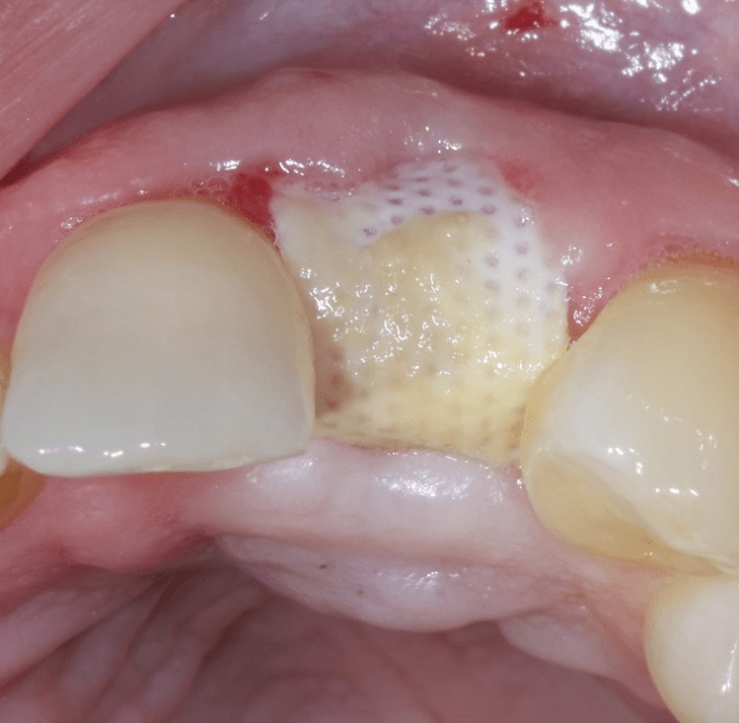 crestal view 4-weeks after extraction and sutureless membrane