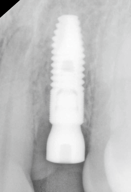 implant placed 4 weeks after extraction when membrane is removed