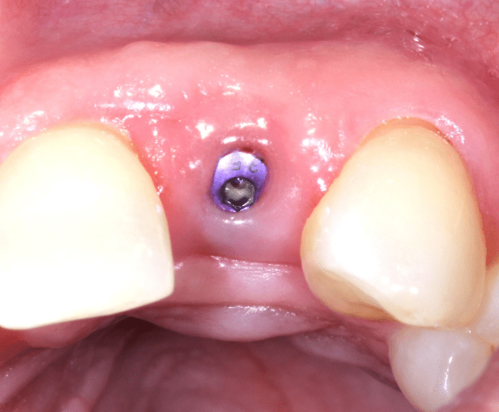 #10, 6 weeks after implant placement