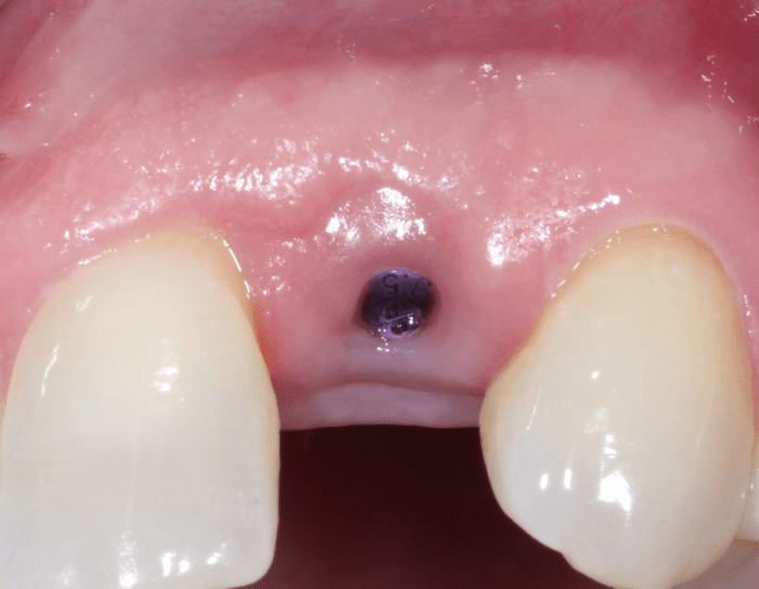 early implant placement, buccal view
