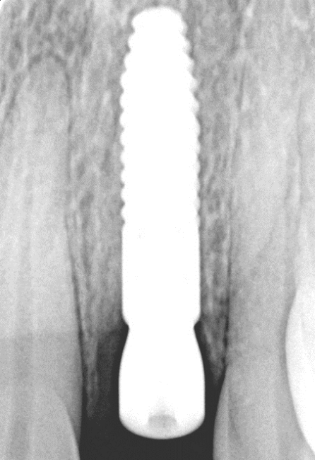 #10, 6 weeks after implant placement using early implant protocol