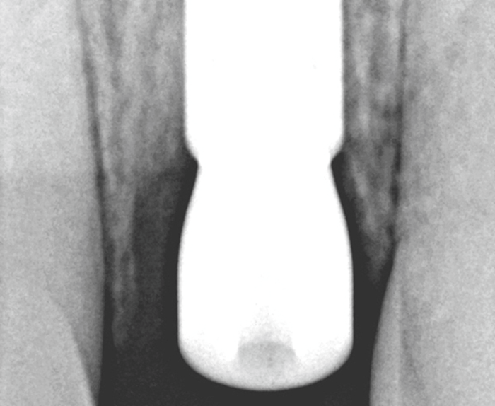 complete coverage of implant surface