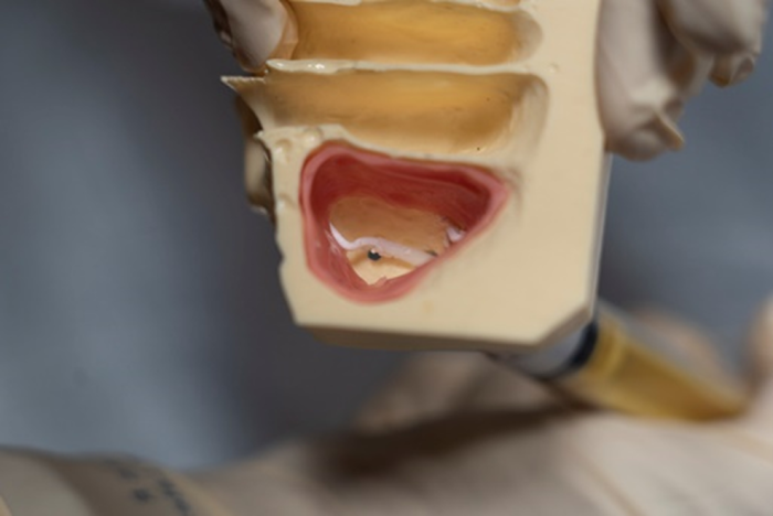 Sinus Graft injected into model of sinus