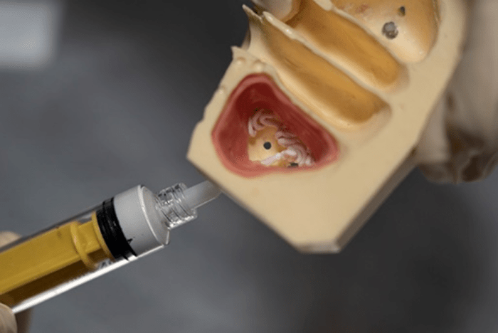 Sinus Graft injected into model of sinus