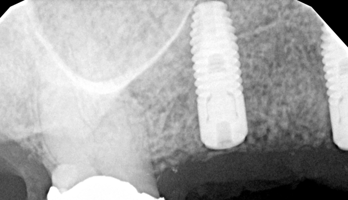 implant placed after sinus membrane removal and grafting
