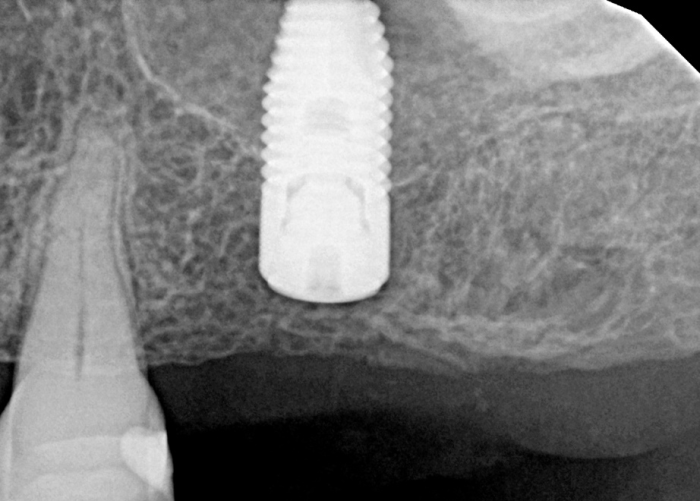 healing abutment appointment with sinus filled with bone