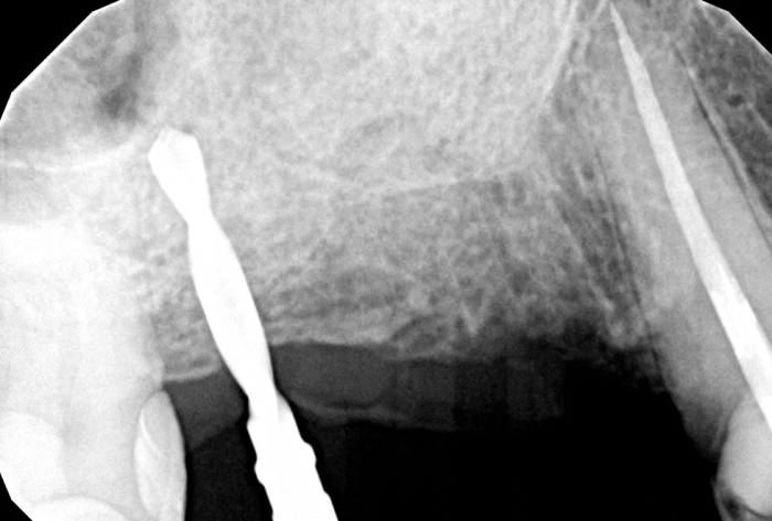 osteotomy prepared for distal implant and mesial sinus grafted