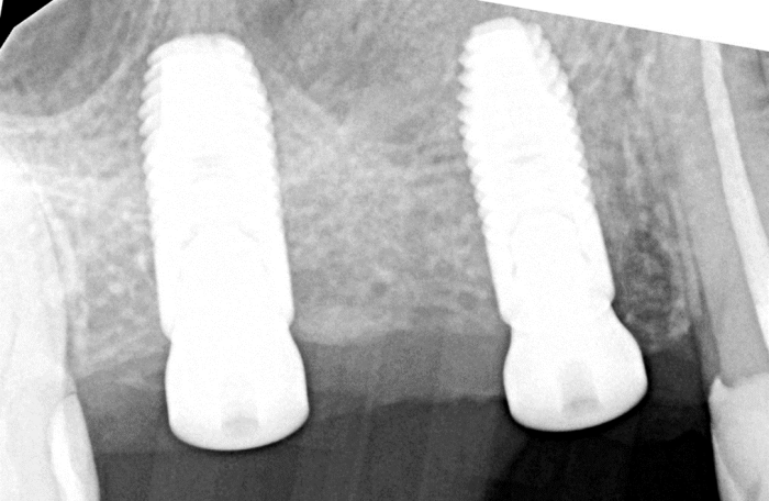 6 months after distal implant placement, sinus removal, and socket grafting