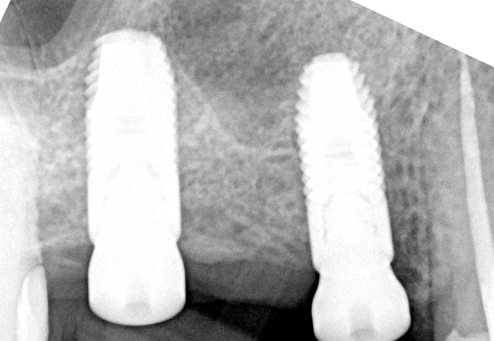 6 weeks after mesial implant placement