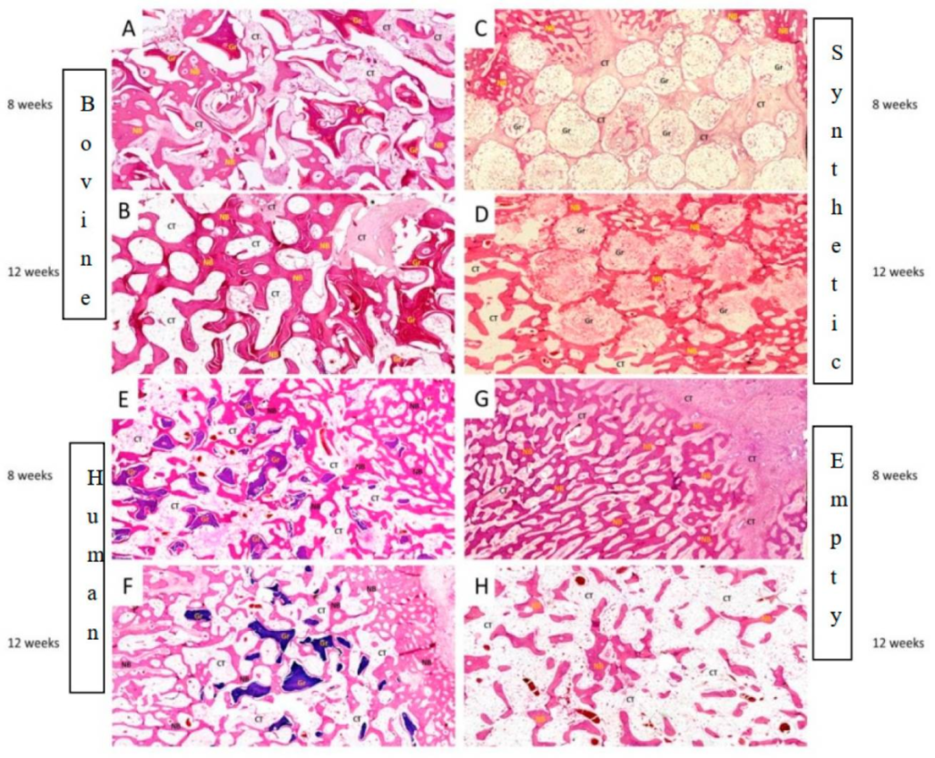 βTCP superior to allograft and xenograft