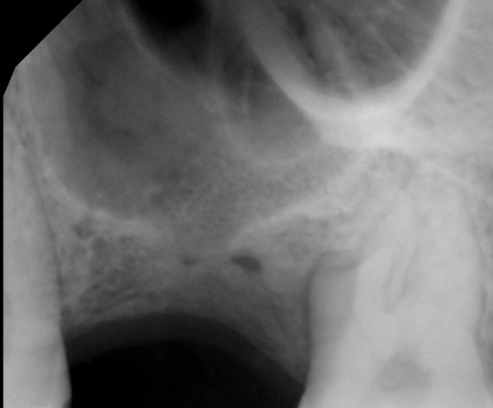 approximately 4 mm of crestal bone