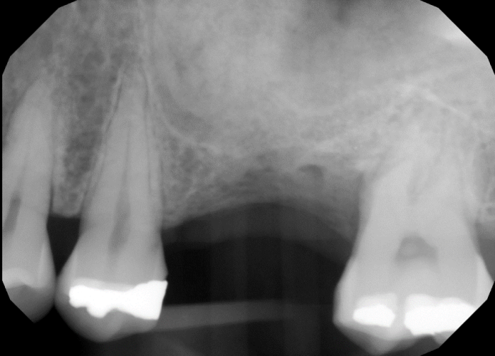 voids on floor of sinus and distal to osteotomy