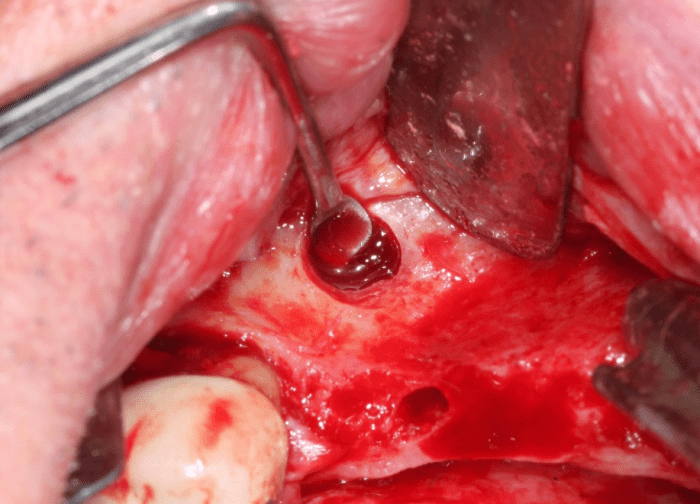 sinus membrane removed through lateral wall osteotomy