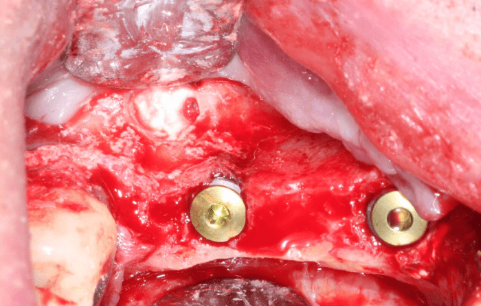 implant placed after sinus grafting