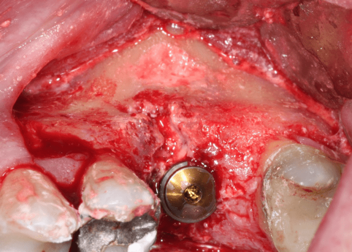 implant placed after sinus grafting