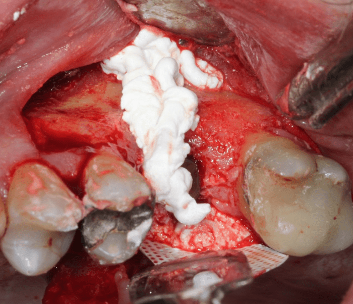 crestal defects grafted with Socket Graft Injectable