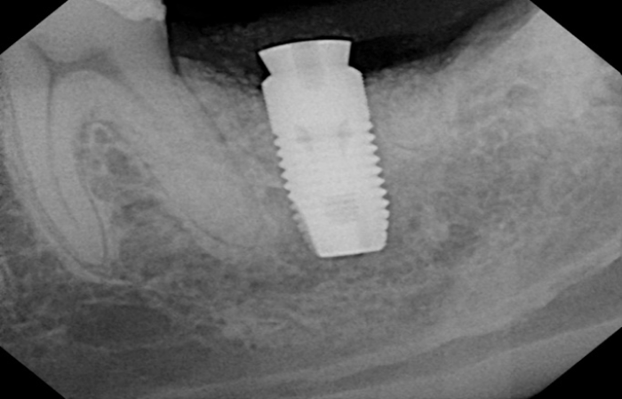 implant placement with submerged cover screw