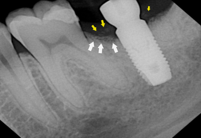 marginal bone loss at the crest with bone particles in the gingiva