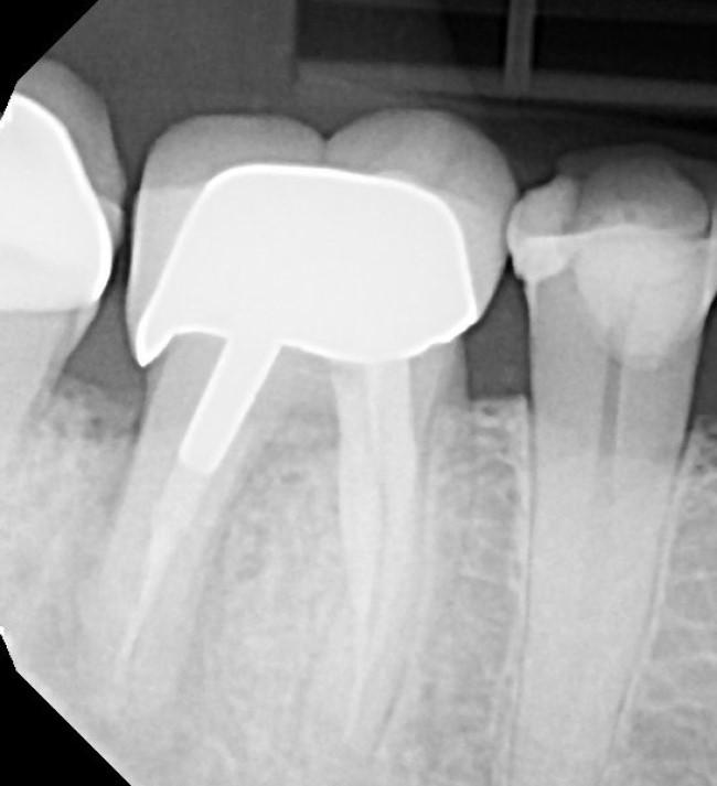 Radiographs with missing buccal wall grafted with Socket Graft Plus