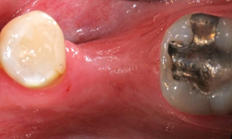 resorbed buccal and lingual ridge after grafting with allograft