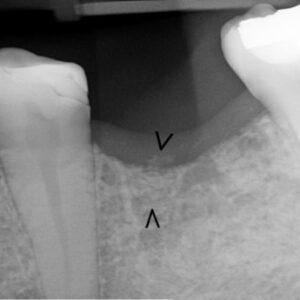 Socket Graft Plus vs Allograft