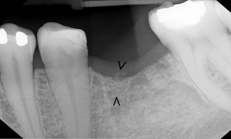 radiograph showing poor mineralization