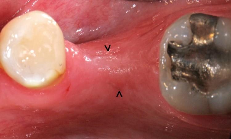 areas of allograft particles exiting the gingiva
