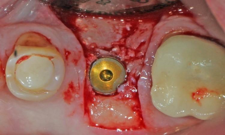 implant placement