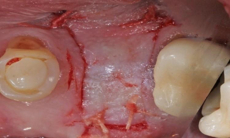 site closed with sutures and bonded with Oral Bond